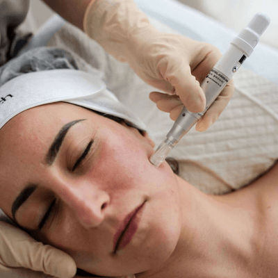 Lady with eyes closed having a facial with a skin needling device